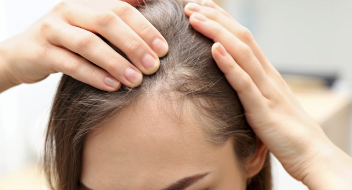 남성 탈모에 대한 효과적인 솔루션